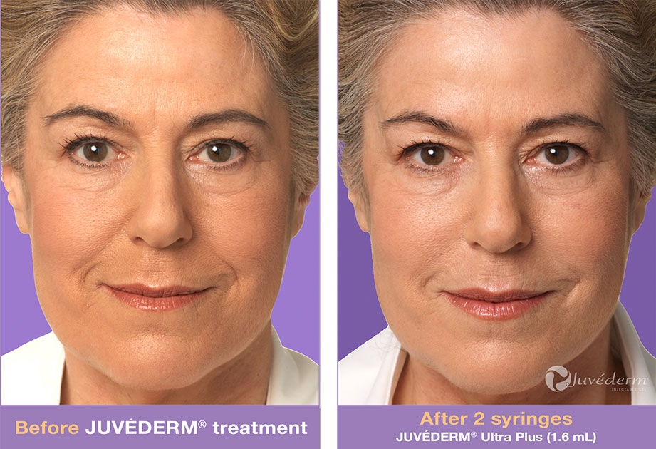 Juvederm Lip Augmentation Richmond Midlothian VA