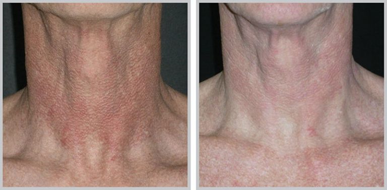 BroadBand Light BBL Therapy Richmond VA