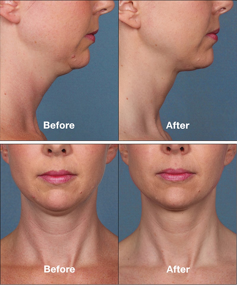 KYBELLA Double Chin Treatment Richmond VA