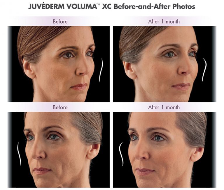 JUVÉDERM VOLUMA XC Cheek Filler Richmond Midlothian VA